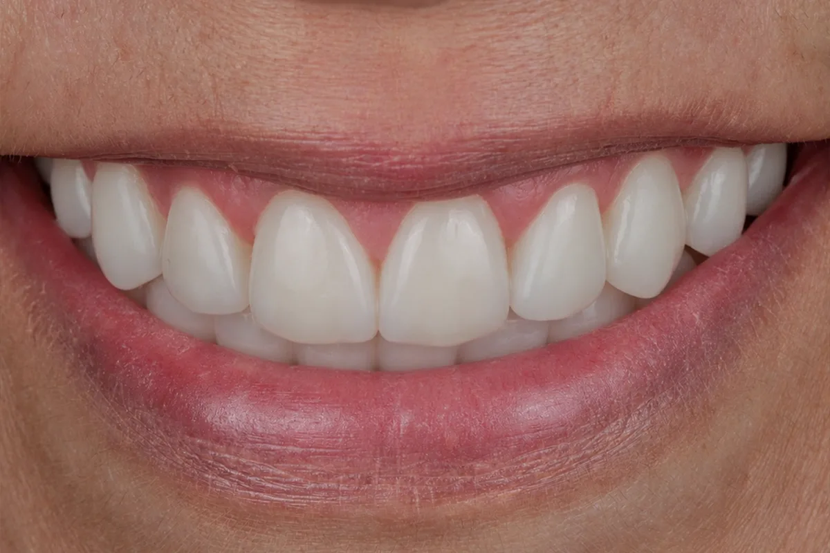 filling treatment